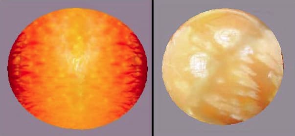 calcareous concretions - melo pearl colors